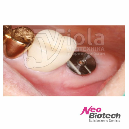 Скан формирователь десны, Neobiotech