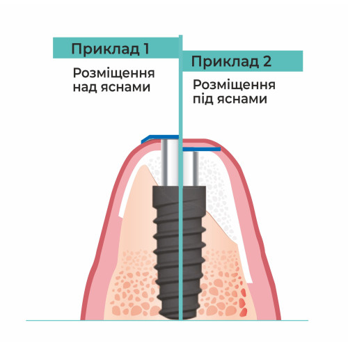 Гвинт-заглушка, Dental Studio