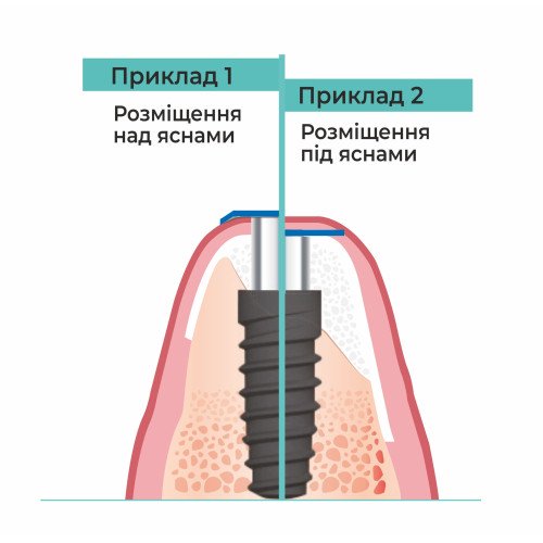 Винт-заглушка, Dental Studio