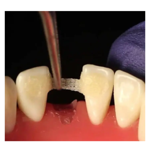 Лента для шинирования Dengen Dental