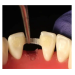 Лента для шинирования Dengen Dental