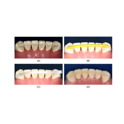 Лента для шинирования Dengen Dental