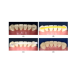 Лента для шинирования Dengen Dental
